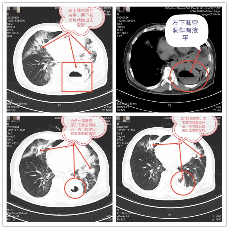 肺脓肿ct图片
